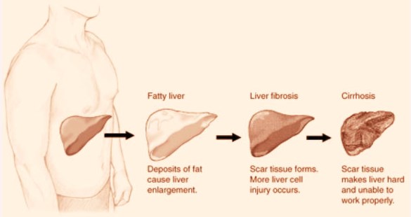 Stages of liver disease.